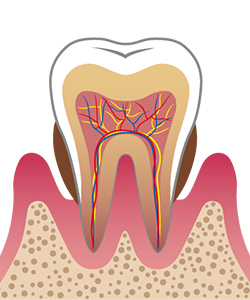 3.中度歯周病